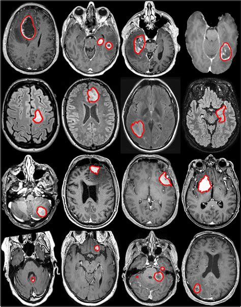 Can a CT Scan Show a Brain Tumor? And Why Do Pineapples Dream of Electric Sheep?