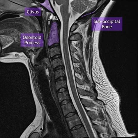 Does Occipital Neuralgia Show Up on MRI: A Journey Through the Labyrinth of Medical Imaging and Mystical Headaches